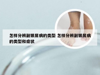 怎样分辨副银屑病的类型 怎样分辨副银屑病的类型和症状
