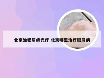 北京治银屑病光疗 北京哪里治疗银屑病