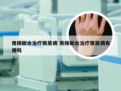用辣椒水治疗银屑病 用辣椒水治疗银屑病有用吗