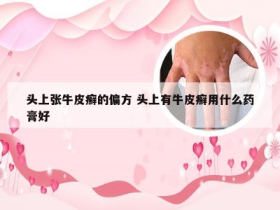 头上张牛皮癣的偏方 头上有牛皮癣用什么药膏好