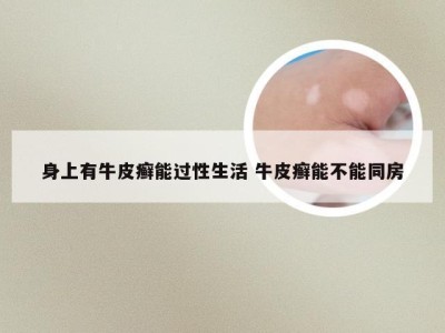 身上有牛皮癣能过性生活 牛皮癣能不能同房