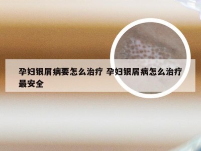 孕妇银屑病要怎么治疗 孕妇银屑病怎么治疗最安全