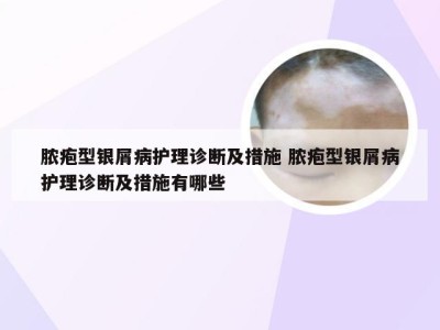 脓疱型银屑病护理诊断及措施 脓疱型银屑病护理诊断及措施有哪些