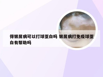 得银屑病可以打球蛋白吗 银屑病打免疫球蛋白有帮助吗