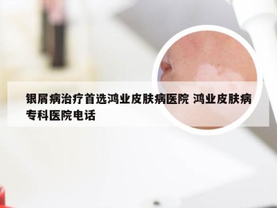 银屑病治疗首选鸿业皮肤病医院 鸿业皮肤病专科医院电话