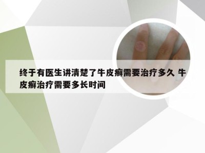 终于有医生讲清楚了牛皮癣需要治疗多久 牛皮癣治疗需要多长时间