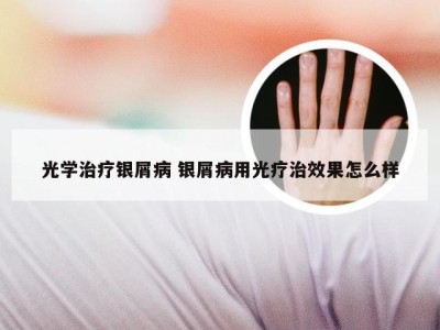 光学治疗银屑病 银屑病用光疗治效果怎么样
