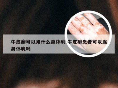 牛皮癣可以用什么身体乳 牛皮癣患者可以涂身体乳吗