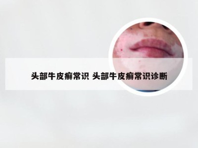 头部牛皮癣常识 头部牛皮癣常识诊断