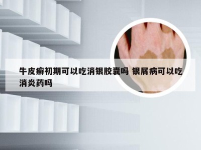 牛皮癣初期可以吃消银胶囊吗 银屑病可以吃消炎药吗