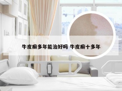 牛皮癣多年能治好吗 牛皮癣十多年