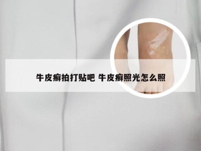 牛皮癣拍打贴吧 牛皮癣照光怎么照