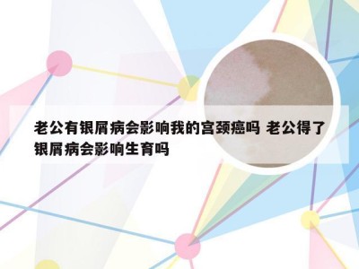 老公有银屑病会影响我的宫颈癌吗 老公得了银屑病会影响生育吗