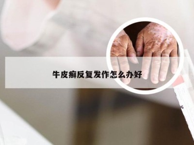 牛皮癣反复发作怎么办好