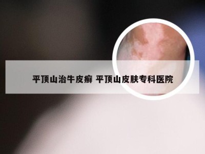 平顶山治牛皮癣 平顶山皮肤专科医院