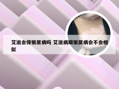 艾滋会得银屑病吗 艾滋病跟银屑病会不会相似
