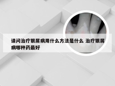 请问治疗银屑病用什么方法是什么 治疗银屑病哪种药最好
