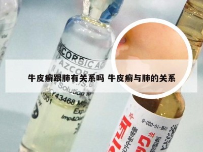 牛皮癣跟肺有关系吗 牛皮癣与肺的关系