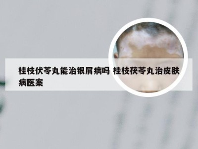 桂枝伏苓丸能治银屑病吗 桂枝茯苓丸治皮肤病医案