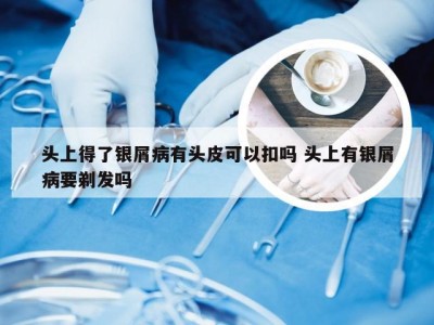 头上得了银屑病有头皮可以扣吗 头上有银屑病要剃发吗