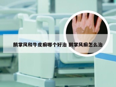 鹅掌风和牛皮癣哪个好治 鹅掌风癣怎么治