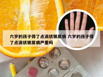 六岁的孩子得了点滴状银屑病 六岁的孩子得了点滴状银屑病严重吗