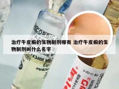 治疗牛皮癣的生物制剂哪有 治疗牛皮癣的生物制剂叫什么名字