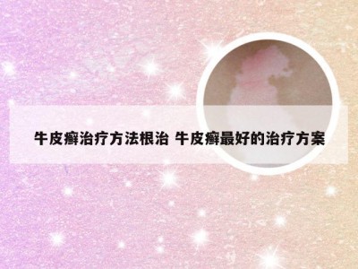 牛皮癣治疗方法根治 牛皮癣最好的治疗方案