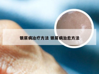 银屑病冶疗方法 银屑病治愈方法