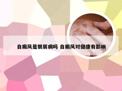 自癜风是银屑病吗 自癜风对健康有影响