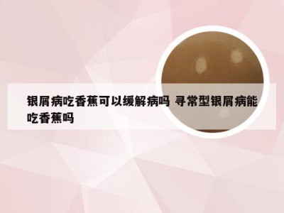 银屑病吃香蕉可以缓解病吗 寻常型银屑病能吃香蕉吗