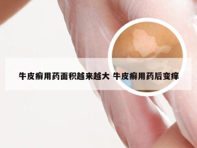 牛皮癣用药面积越来越大 牛皮癣用药后变痒