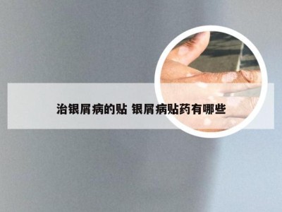 治银屑病的贴 银屑病贴药有哪些
