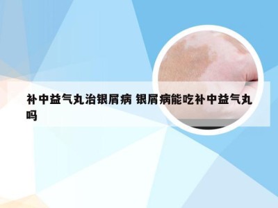 补中益气丸治银屑病 银屑病能吃补中益气丸吗