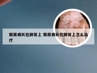 银屑病长在脚背上 银屑病长在脚背上怎么治疗