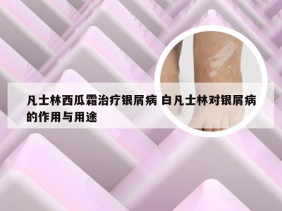 凡士林西瓜霜治疗银屑病 白凡士林对银屑病的作用与用途