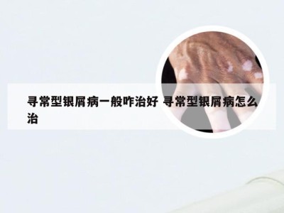 寻常型银屑病一般咋治好 寻常型银屑病怎么治
