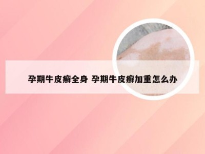 孕期牛皮癣全身 孕期牛皮癣加重怎么办