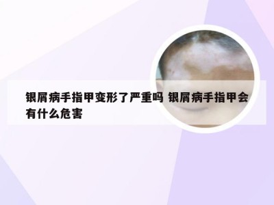 银屑病手指甲变形了严重吗 银屑病手指甲会有什么危害