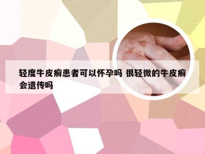 轻度牛皮癣患者可以怀孕吗 很轻微的牛皮癣会遗传吗