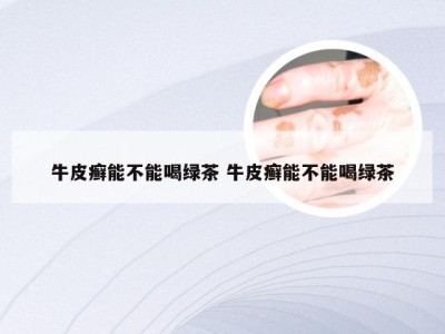 牛皮癣能不能喝绿茶 牛皮癣能不能喝绿茶