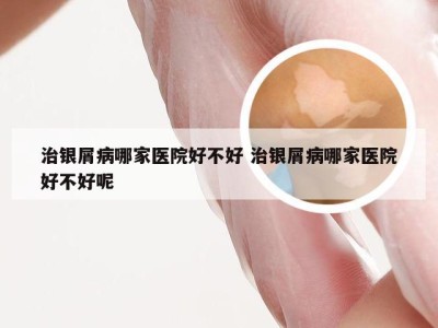 治银屑病哪家医院好不好 治银屑病哪家医院好不好呢