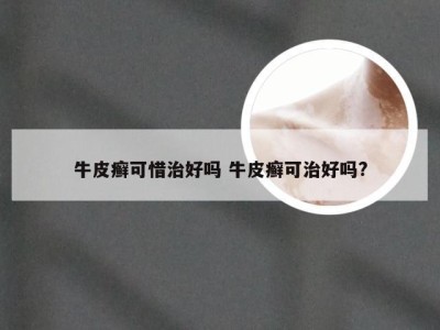 牛皮癣可惜治好吗 牛皮癣可治好吗?