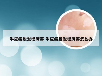 牛皮癣脱发很厉害 牛皮癣脱发很厉害怎么办