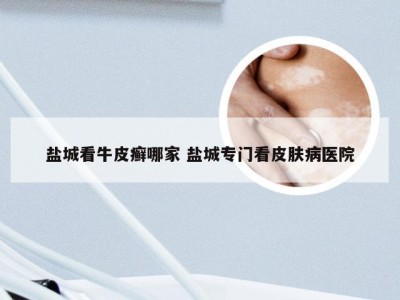 盐城看牛皮癣哪家 盐城专门看皮肤病医院