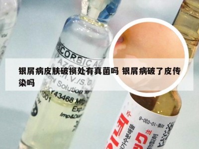 银屑病皮肤破损处有真菌吗 银屑病破了皮传染吗