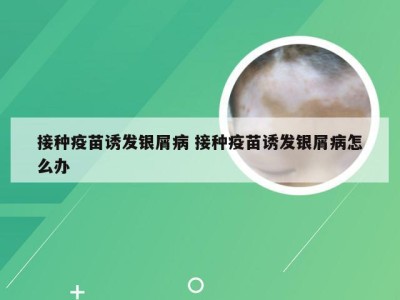 接种疫苗诱发银屑病 接种疫苗诱发银屑病怎么办
