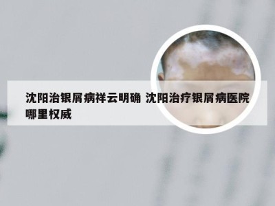 沈阳治银屑病祥云明确 沈阳治疗银屑病医院哪里权威
