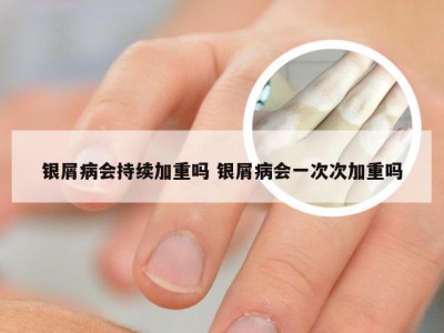 银屑病会持续加重吗 银屑病会一次次加重吗