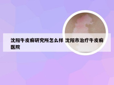 沈阳牛皮癣研究所怎么样 沈阳市治疗牛皮癣医院
